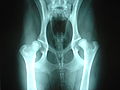 worry wart hip replacement